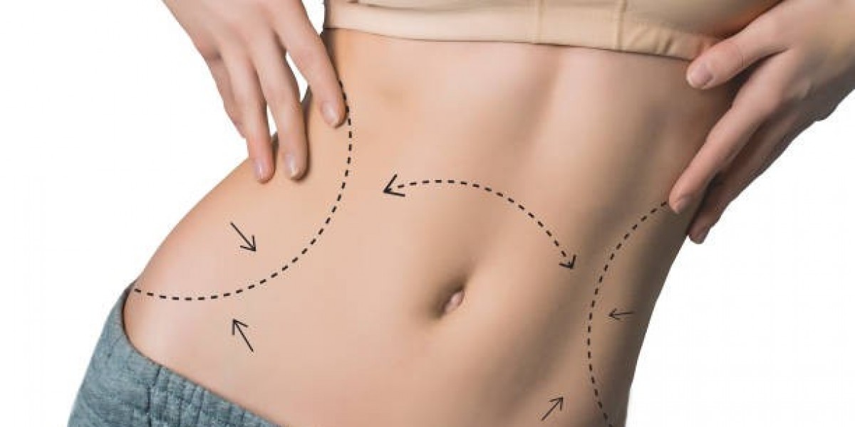 Body Sculpting Procedure Explained for Body Contour Improvement