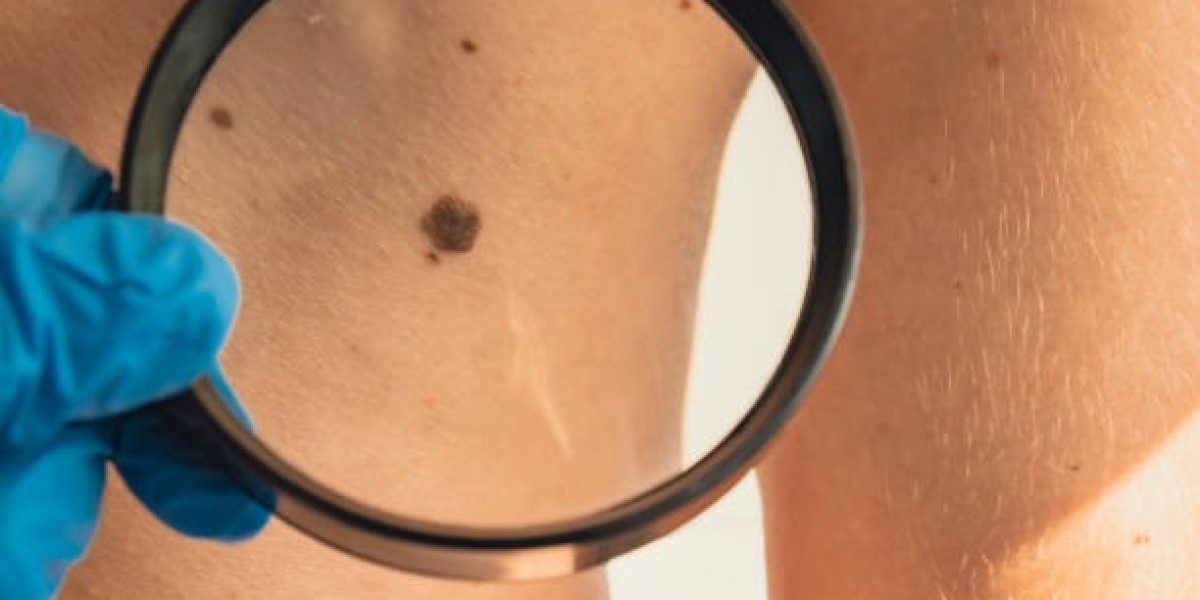 Mole Removal: Protect Your Skin Future