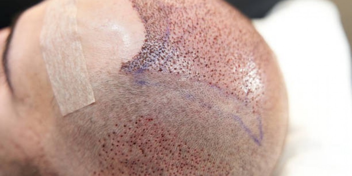 Hair Transplant Myths vs Real Facts