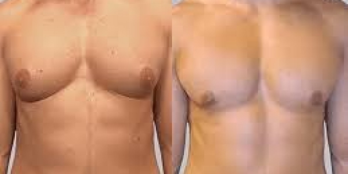 Understanding Body Fat and Gynecomastia Link in Men
