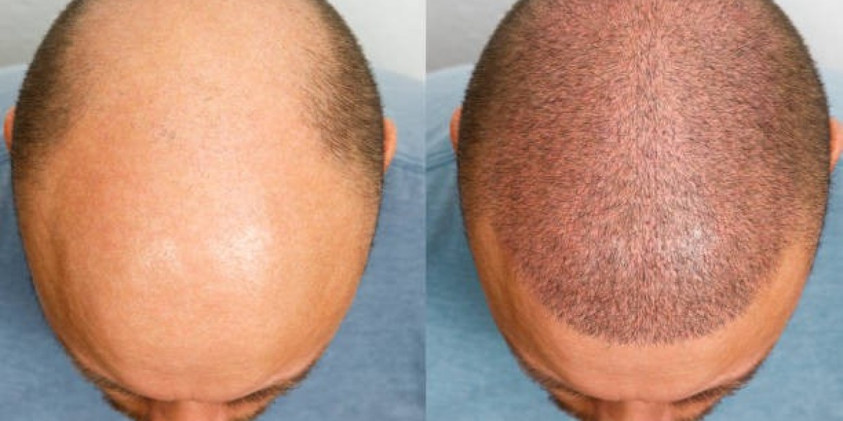 Hair Transplant Outcomes and Natural-Looking Hair Growth