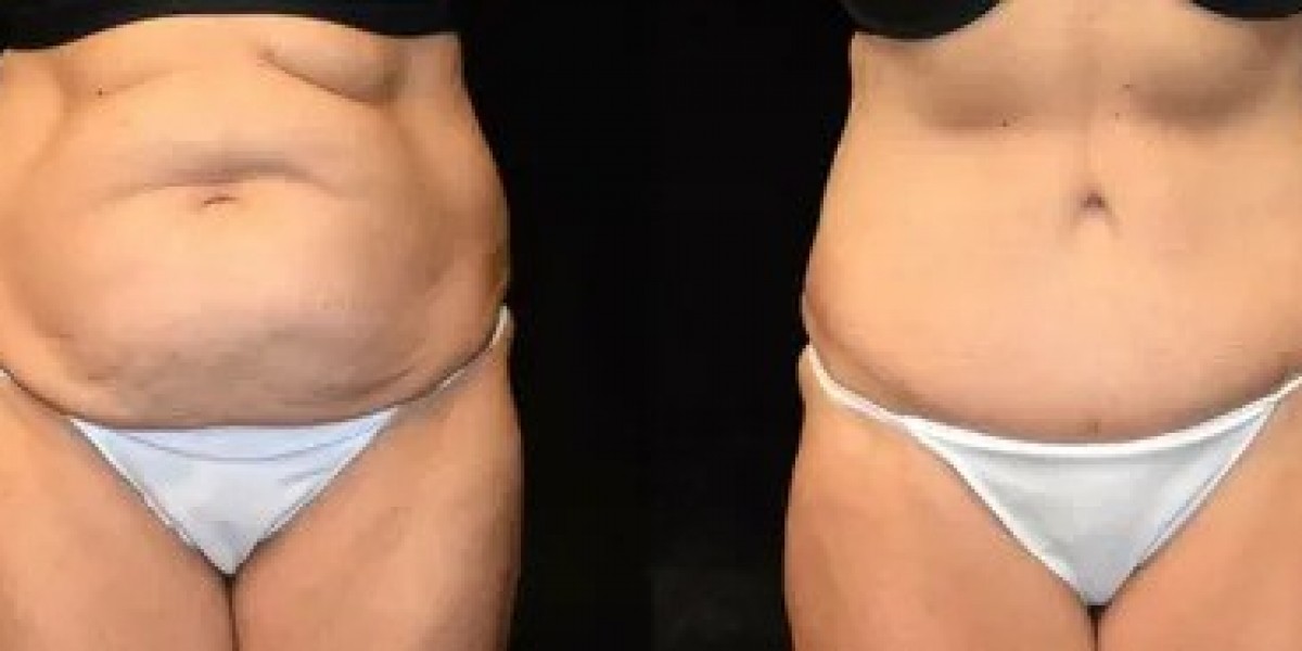 Tummy Tuck in Islamabad for Loose Skin After Pregnancy