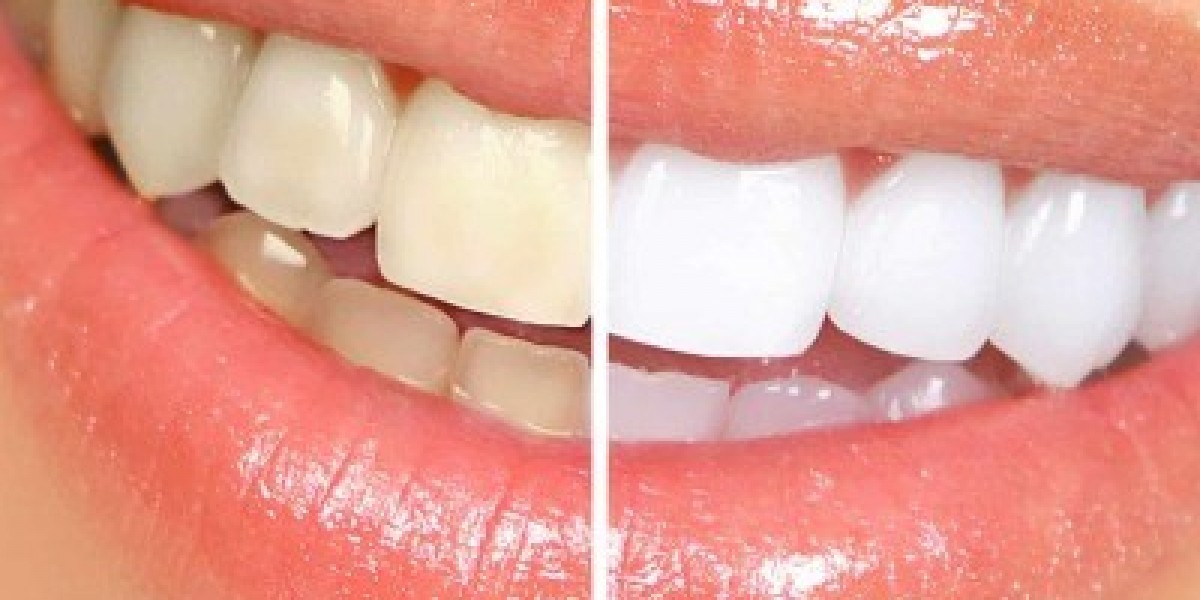 Advanced Cosmetic Teeth Whitening in Islamabad