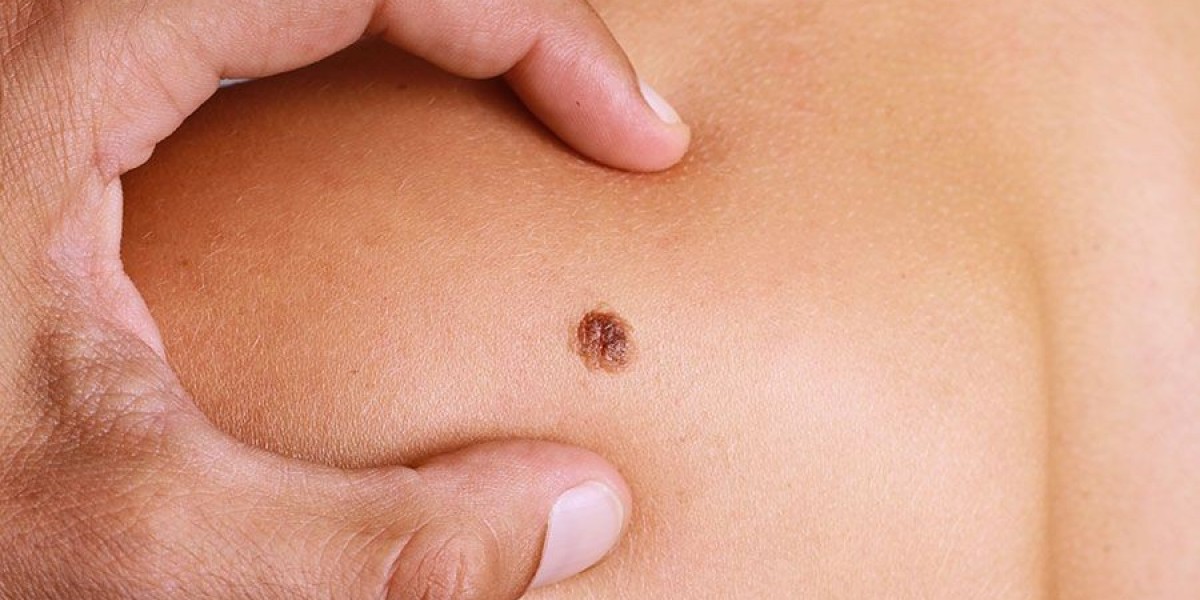 الحل الطبي الآمن هو إزالة الزوائد الجلدية في رويال كلينك