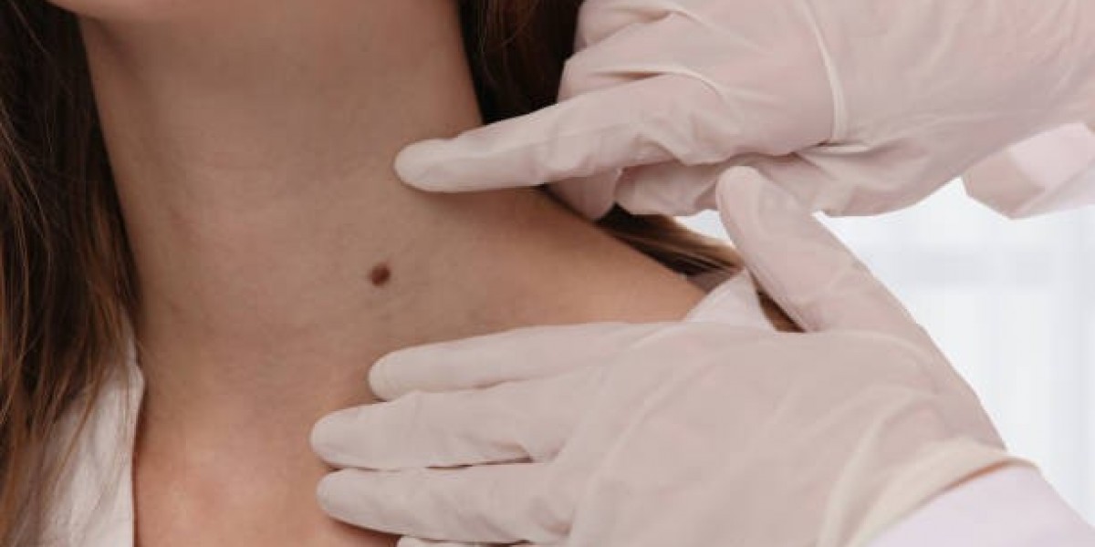 Skin Tag Removal Insights for Better Skin Confidence