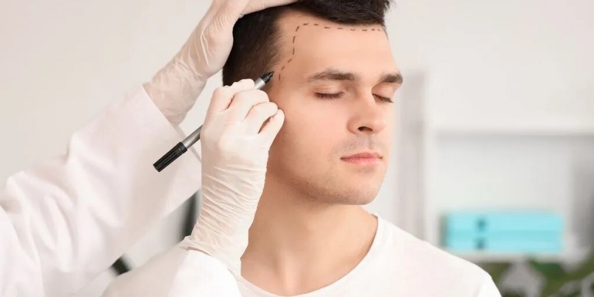 Hair Transplant Procedure for Fuller Hair