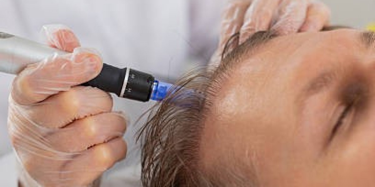 Exosomes Therapy for Hair Loss: Advanced Stem Cell Alternative