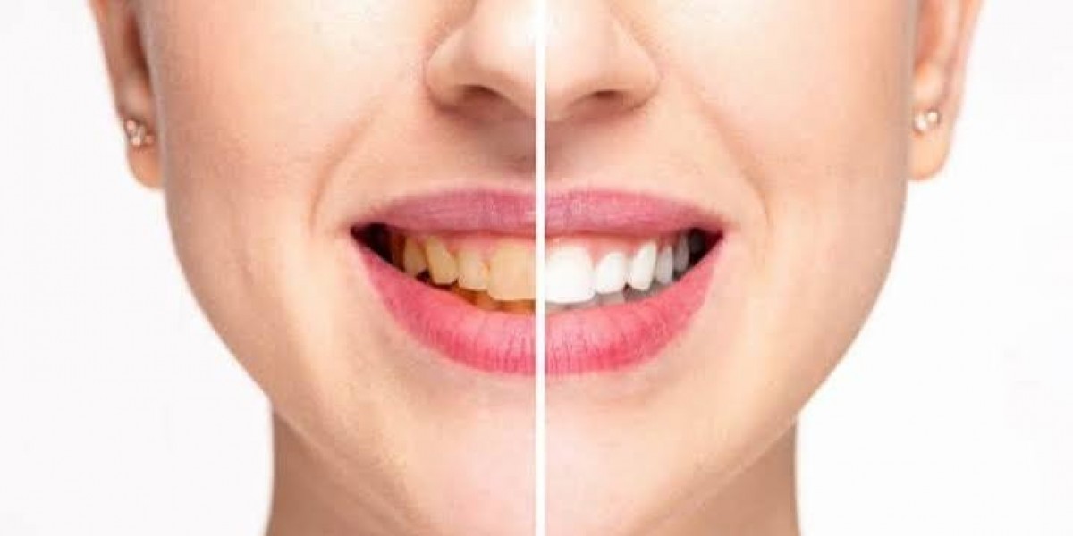 Teeth Whitening for Smokers: Challenges, Results, and Maintenance Considerations